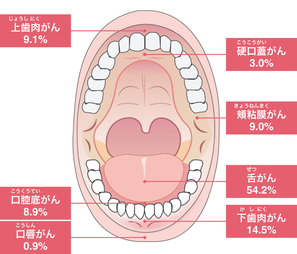 発生部位