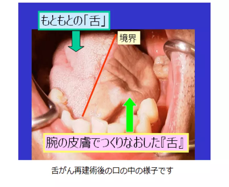 再建手術